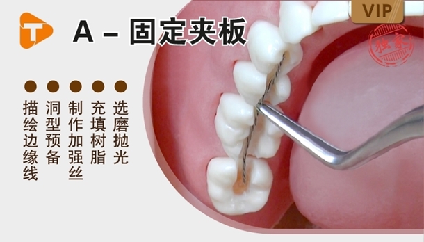 夹板固定牙齿示意图图片